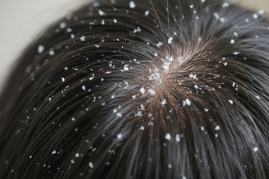 Pellicules Cheveux : Causes & Remèdes Naturels au Maroc